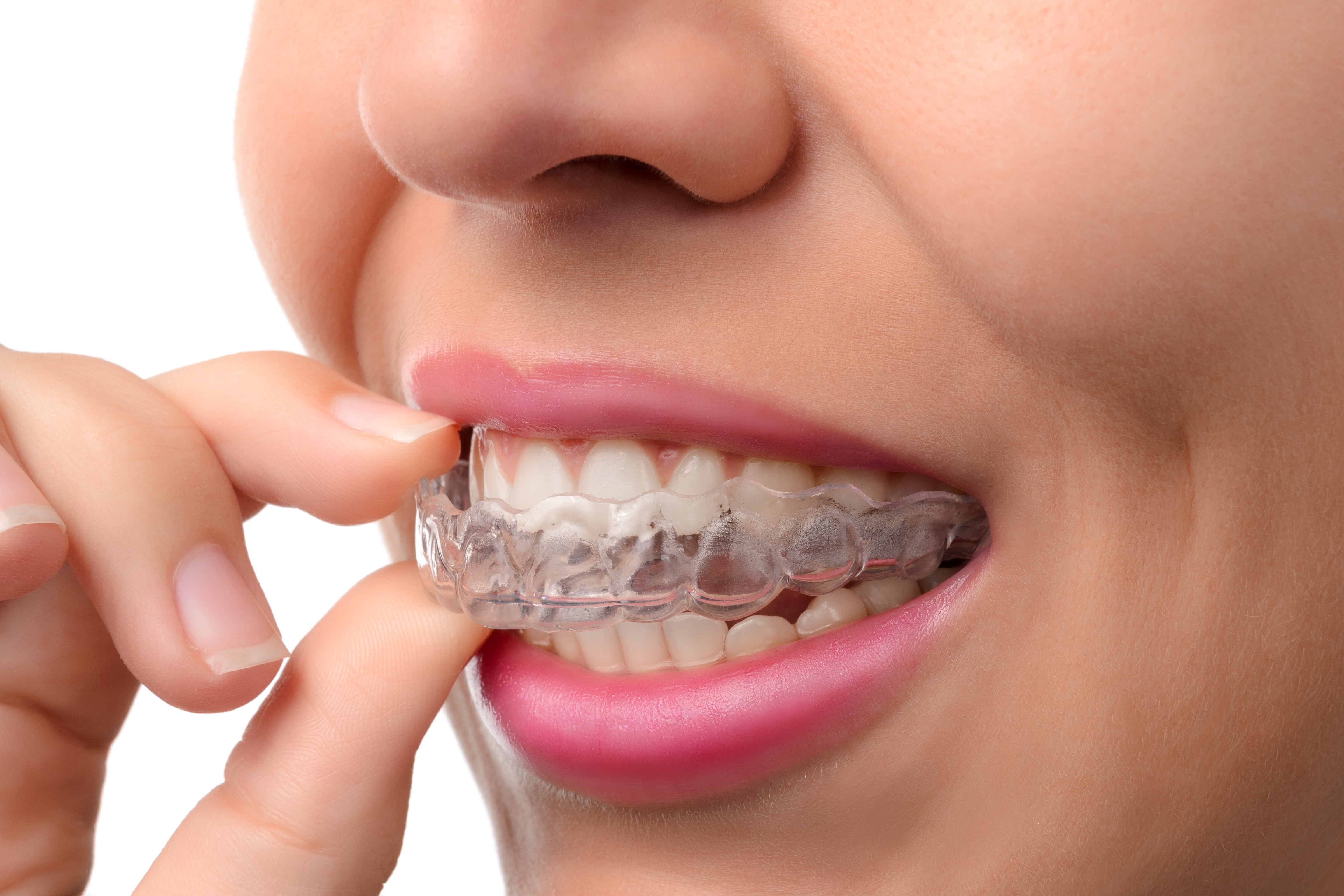 Is Invisalign Right For Me?