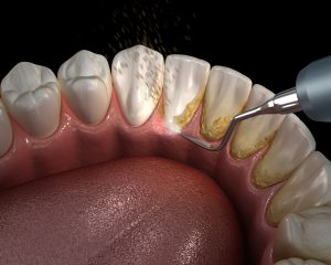 https://smithdentistry.net/wp-content/uploads/2019/05/smith-deep-cleaning-300x240.jpeg