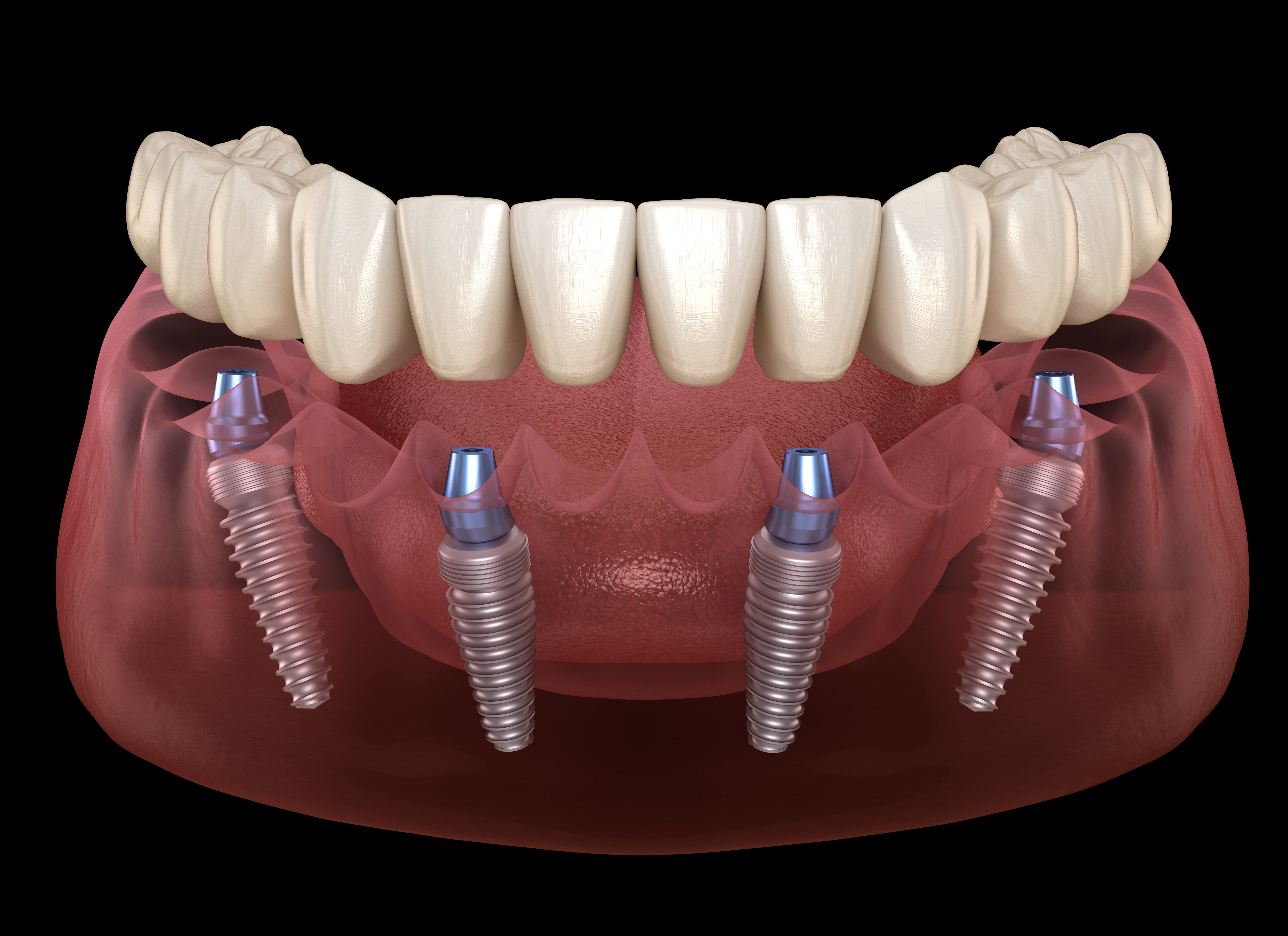 Имплант. Балочный протез на 4 имплантах. Имплантологическая кассета Nobel полный набор для all on 4. Имплантация зубов по технологии «all on 4».