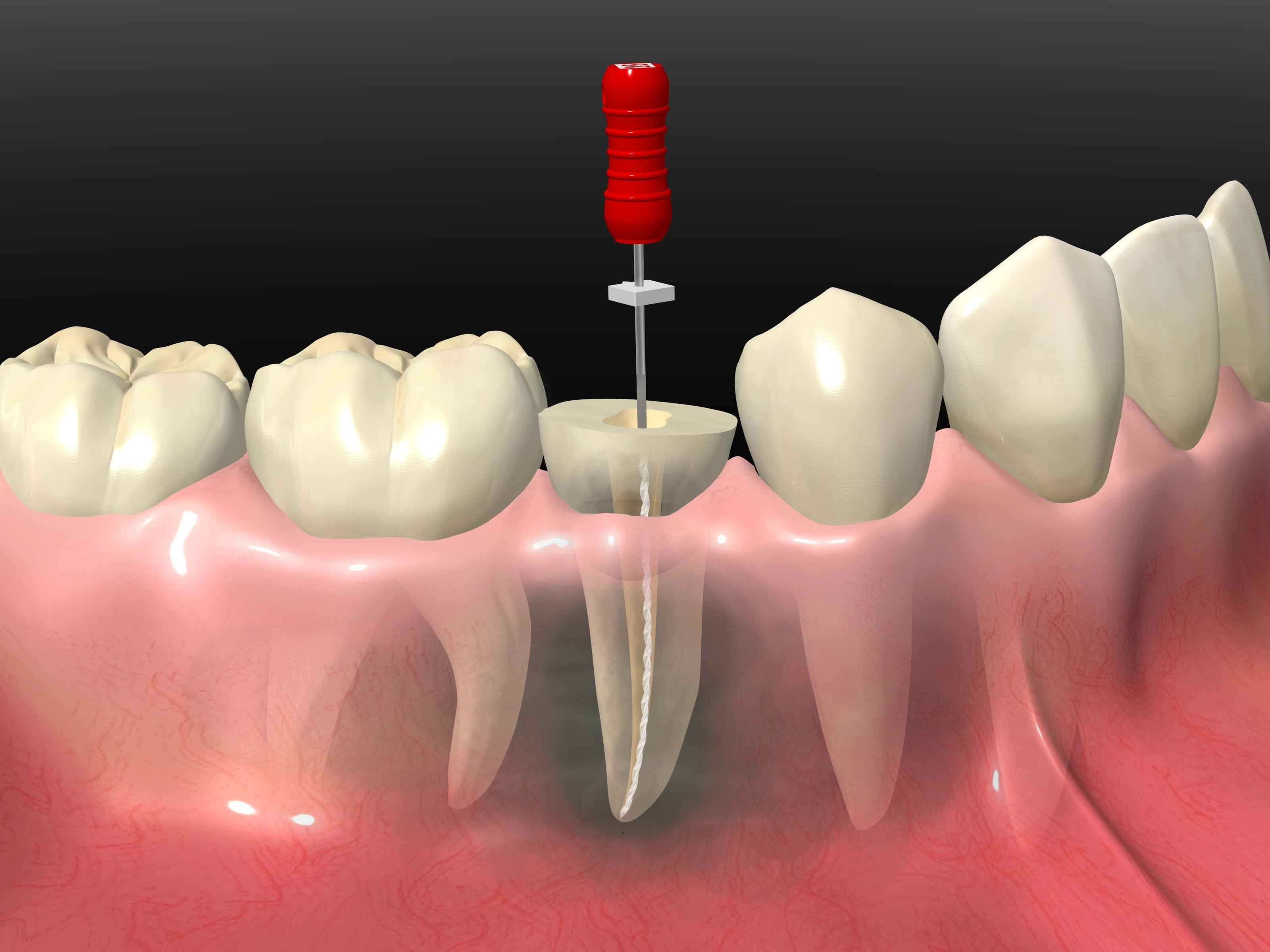 Удаление каналов в зубе