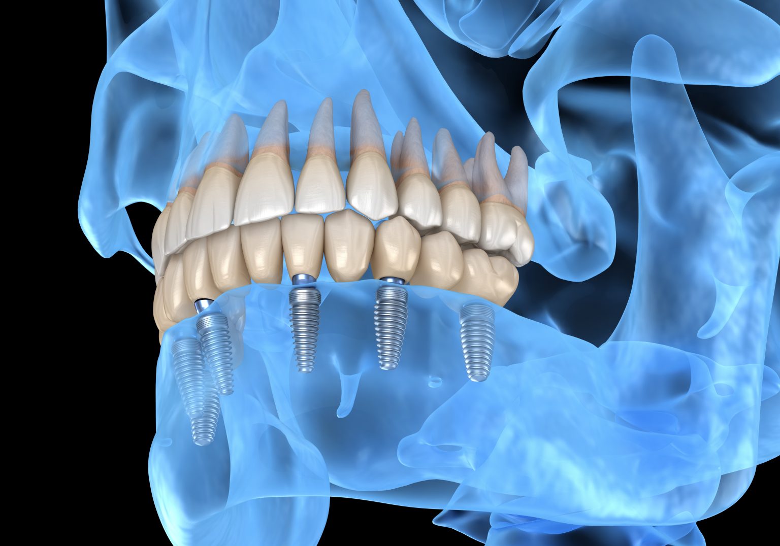 Greenville Dentist Uses Dental Implants To Preserve Smiles Smith