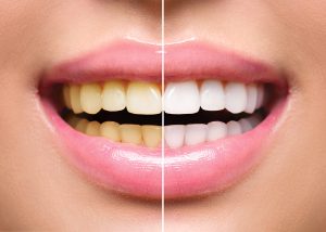 greenville teeth whitening