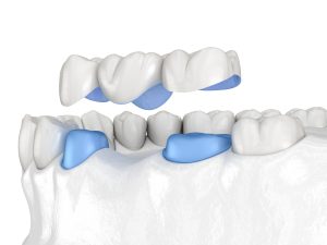 dental bridge